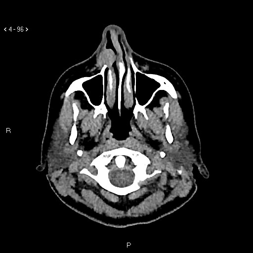 File:Nasolabial cyst (Radiopaedia 75125-86194 Axial non-contrast 58).jpg