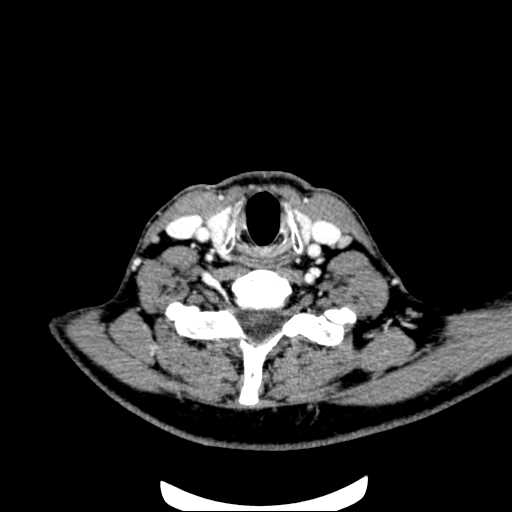 File:Nasopharyngeal carcinoma - infiltrating the clivus (Radiopaedia 62583-70875 Axial Post contrast 57).jpg