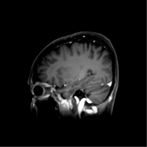File:Nasopharyngeal carcinoma with cerebral abscess (Radiopaedia 43018-46274 J 39).png