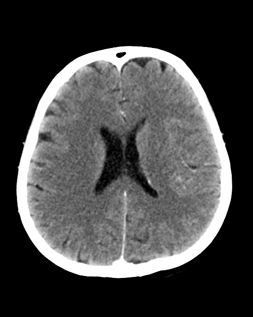 Nasopharyngeal carcinoma with cerebral abscess (Radiopaedia 43018-46275 Axial C+ delayed 32).png