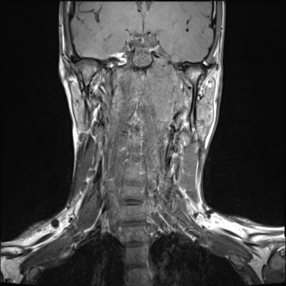 Nasopharyngeal carcinoma with skull base invasion (Radiopaedia 53415-59485 Coronal T1 17).jpg