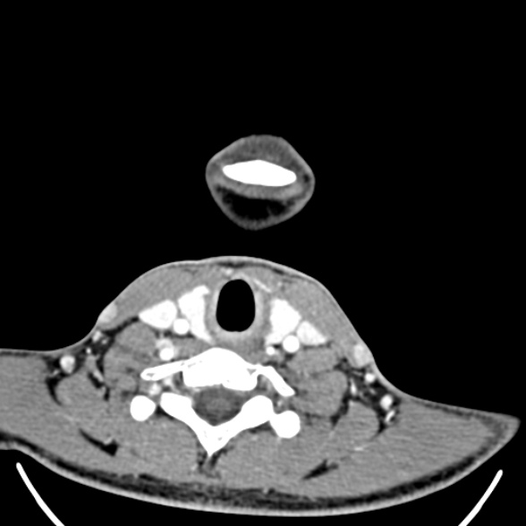 Nasopharyngeal carcinoma with skull base invasion (Radiopaedia 53415-59705 A 166).jpg