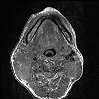 Nasopharyngeal carcinoma with skull base invasion (Radiopaedia 59258-66600 B 41).jpg