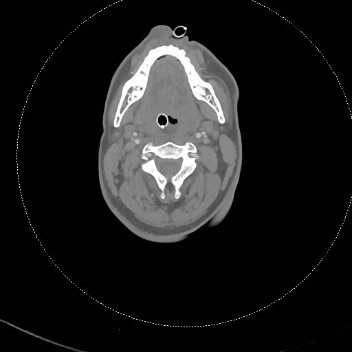 Neck CT angiogram (intraosseous vascular access) (Radiopaedia 55481-61945 B 209).jpg