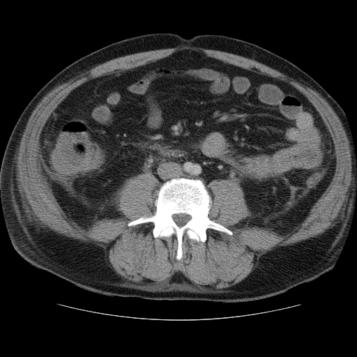File:Necrotizing pancreatitis - acute necrotic collection maturing into walled-off pancreatic necrosis (Radiopaedia 9602-10249 A 13).jpg