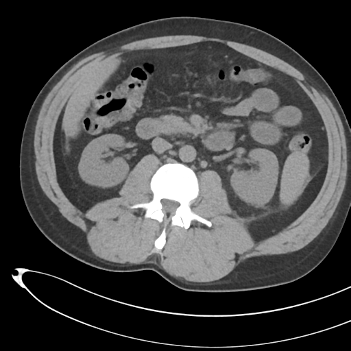 File:Necrotizing pancreatitis with acute necrotic collections (Radiopaedia 38829-41012 Axial non-contrast 39).png