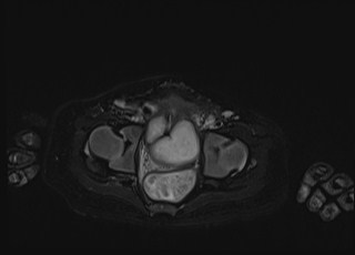 Neonatal prostatic utricle abscess - cyst (Radiopaedia 69511-79394 Axial T2 fat sat 16).jpg