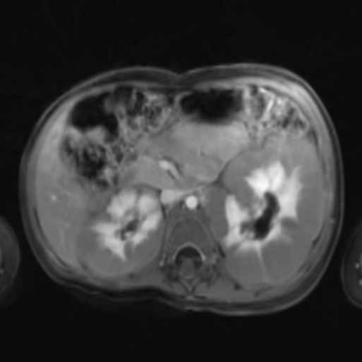 File:Nephroblastomatosis (Radiopaedia 39984-42477 D 1).png