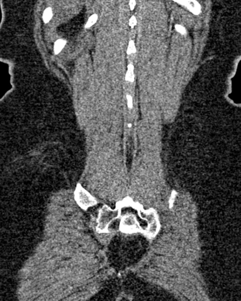 File:Nephrostomy for urosepsis (Radiopaedia 26180-26330 non-contrast 78).jpg