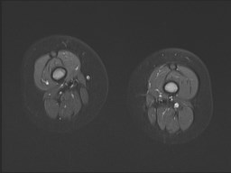 File:Neuroblastoma with bone metastases (Radiopaedia 67080-76414 Axial STIR 21).jpg