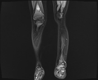 File:Neuroblastoma with bone metastases (Radiopaedia 67080-76414 B 4).jpg