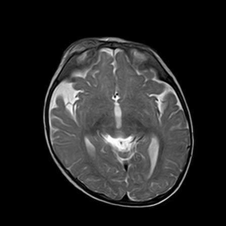 File:Neurofibromatosis type 1 (Radiopaedia 30089-30671 Axial T2 11).jpg