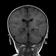 File:Neurofibromatosis type 1 (Radiopaedia 30089-30671 Coronal T1 18).jpg