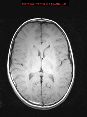 File:Neurofibromatosis type 1 with optic nerve glioma (Radiopaedia 16288-15965 Axial T1 11).jpg