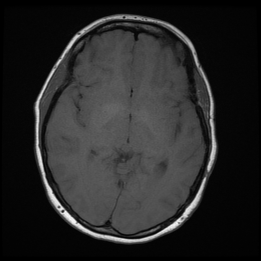 File:Neurofibromatosis type 2 (Radiopaedia 45229-49247 Axial T1 11).png