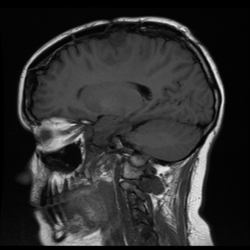 File:Neurofibromatosis type 2 (Radiopaedia 45229-49251 Sagittal T1 13).png