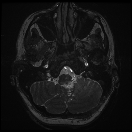 Neurofibromatosis type 2 - bilateral acoustic neuromata (Radiopaedia 40060-42566 Axial FIESTA 13).png