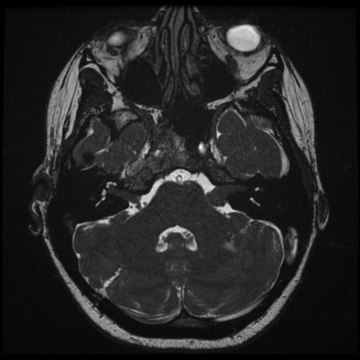 File:Neurofibromatosis type 2 - bilateral acoustic neuromata (Radiopaedia 40060-42566 Axial FIESTA 38).png