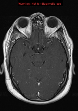 File:Neuroglial cyst (Radiopaedia 10713-11184 Axial T1 C+ 15).jpg
