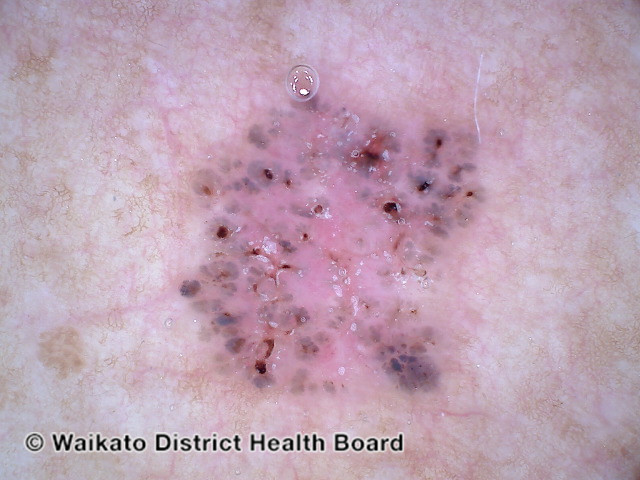 File:Nonpolarised dermoscopy of pigmented basal cell carcinoma (DermNet NZ nonpolarised-pigmented-bcc).jpg