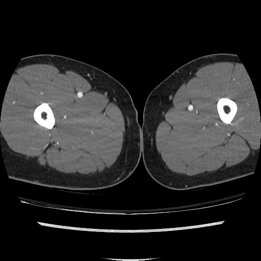 File:Normal CT angiogram of pelvis (Radiopaedia 45390-49430 A 84).jpg