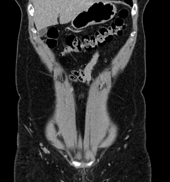 File:Normal CT intravenous urogram (Radiopaedia 39444-41759 A 194).jpg