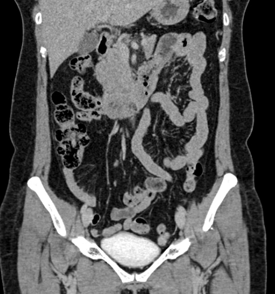 Normal CT intravenous urogram (Radiopaedia 39444-41759 A 239).jpg