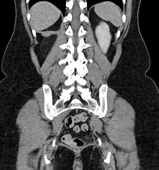 Normal CT intravenous urogram (Radiopaedia 39444-41759 A 341).jpg