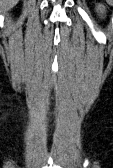 Normal CT lumbar spine (Radiopaedia 53981-60118 F 93).jpg