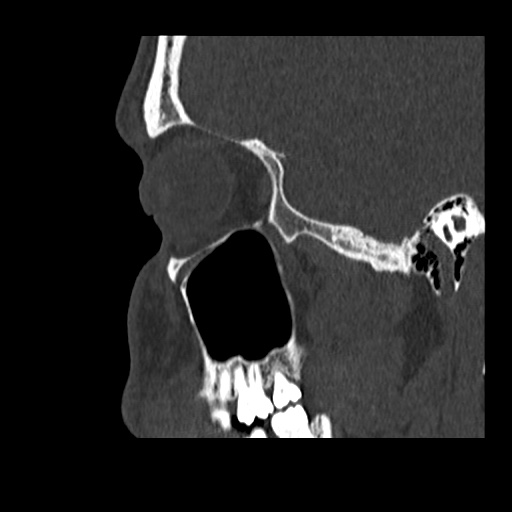 Normal CT paranasal sinuses (Radiopaedia 42286-45390 Sagittal bone window 81).jpg