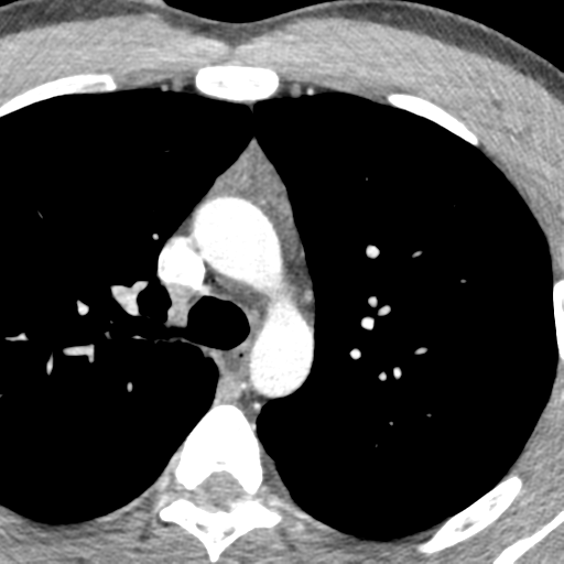 File:Normal CT pulmonary veins (pre RF ablation) (Radiopaedia 41748-44702 A 19).png