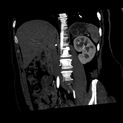 File:Normal CT renal artery angiogram (Radiopaedia 38727-40889 C 13).png