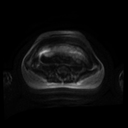 Normal MRI abdomen in pregnancy (Radiopaedia 88001-104541 Axial DWI 101).jpg