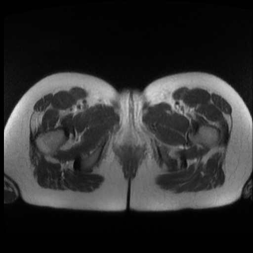 Normal MRI abdomen in pregnancy (Radiopaedia 88003-104546 Axial T2 55).jpg