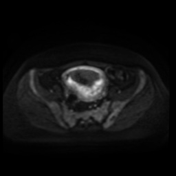 Normal MRI abdomen in pregnancy (Radiopaedia 88005-104548 Axial DWI 60).jpg