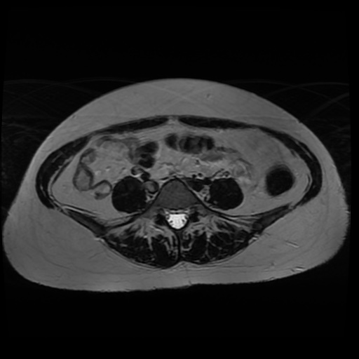 Normal MRI abdomen in pregnancy (Radiopaedia 88005-104548 Axial T2 10).jpg