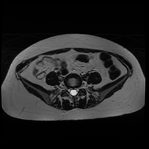 Normal MRI abdomen in pregnancy (Radiopaedia 88005-104548 Axial T2 13).jpg