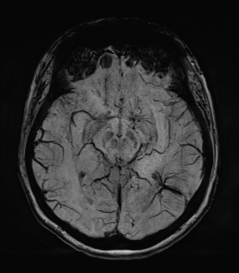 Normal MRI internal auditory canal (Radiopaedia 41613-44525 Axial SWI MIP 35).png