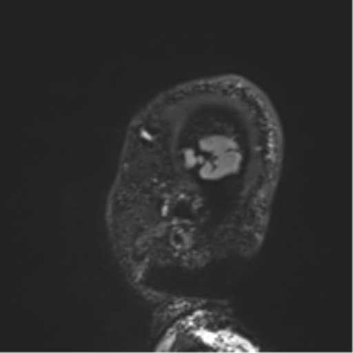 Normal brain MRI (non-focal epilepsy protocol) (Radiopaedia 53917-60040 Sagittal DIR 58).png