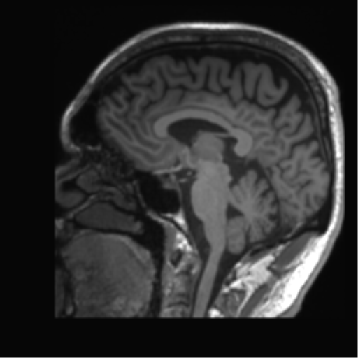 Normal brain MRI (non-focal epilepsy protocol) (Radiopaedia 53917-60040 Sagittal T1 36).png