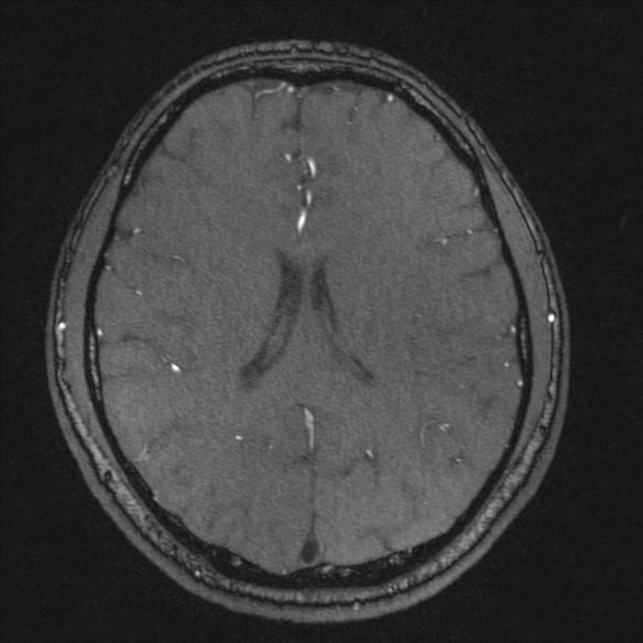 Normal brain MRI including MRA (Radiopaedia 48748-53763 Axial MRA 137).jpg