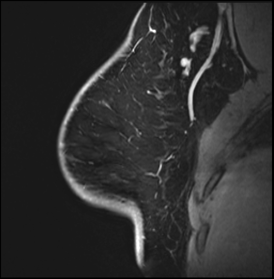 Normal breast MRI - dense breasts (Radiopaedia 80454-93850 I 50).jpg