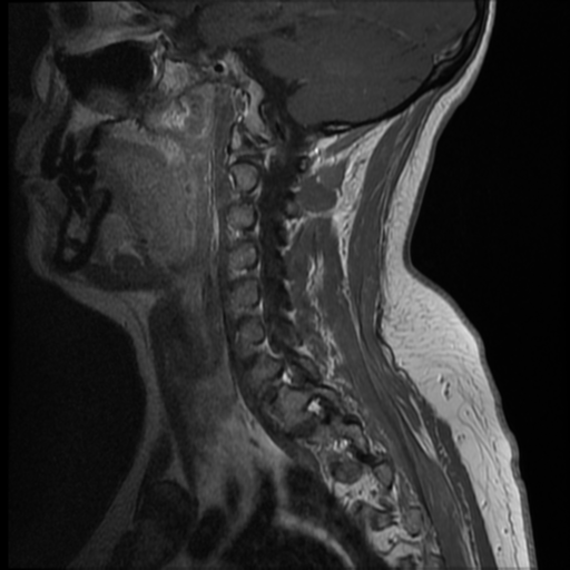 File:Normal cervical and thoracic spine MRI (Radiopaedia 35630-37156 Sagittal T1 C+ 3).png