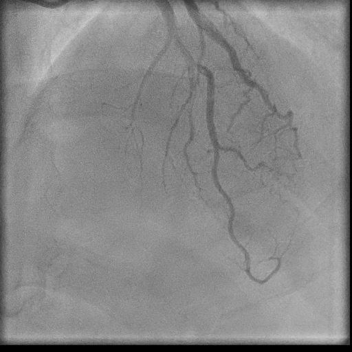 Normal coronary angiogram (DSA) (Radiopaedia 63081-71571 E 63).jpg