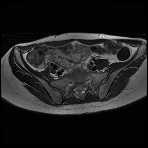 File:Normal female pelvis MRI (retroverted uterus) (Radiopaedia 61832-69933 Axial T2 8).jpg