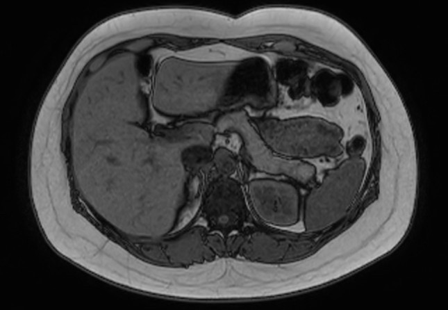 File:Normal liver MRI with Gadolinium (Radiopaedia 58913-66163 B 20).jpg