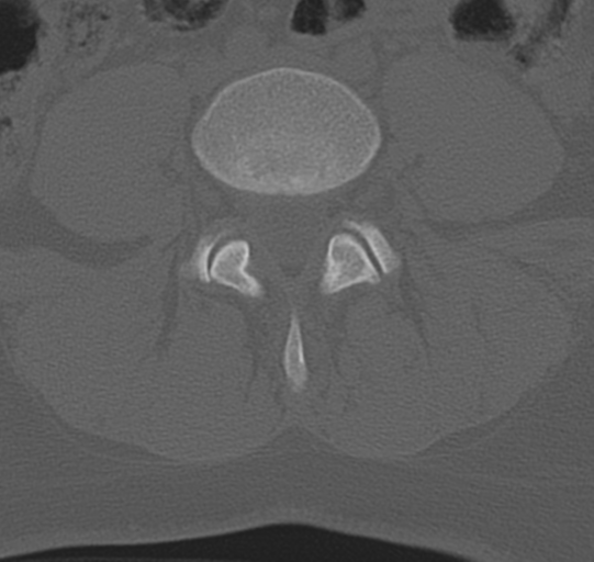 File:Normal lumbar spine CT (Radiopaedia 46533-50986 Axial bone window 52).png