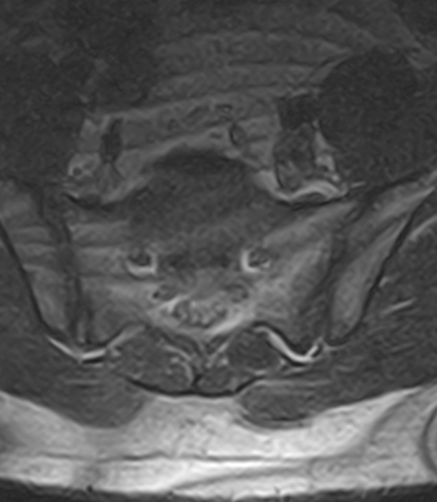 Normal lumbar spine MRI - low-field MRI scanner (Radiopaedia 40976-43699 Axial T2 96).jpg