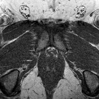 File:Normal prostate (MRI) (Radiopaedia 29986-30535 Axial T1 1).jpg