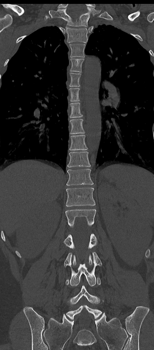 Normal thoracolumbar spine (Radiopaedia 43822-47309 Coronal bone window 52).png